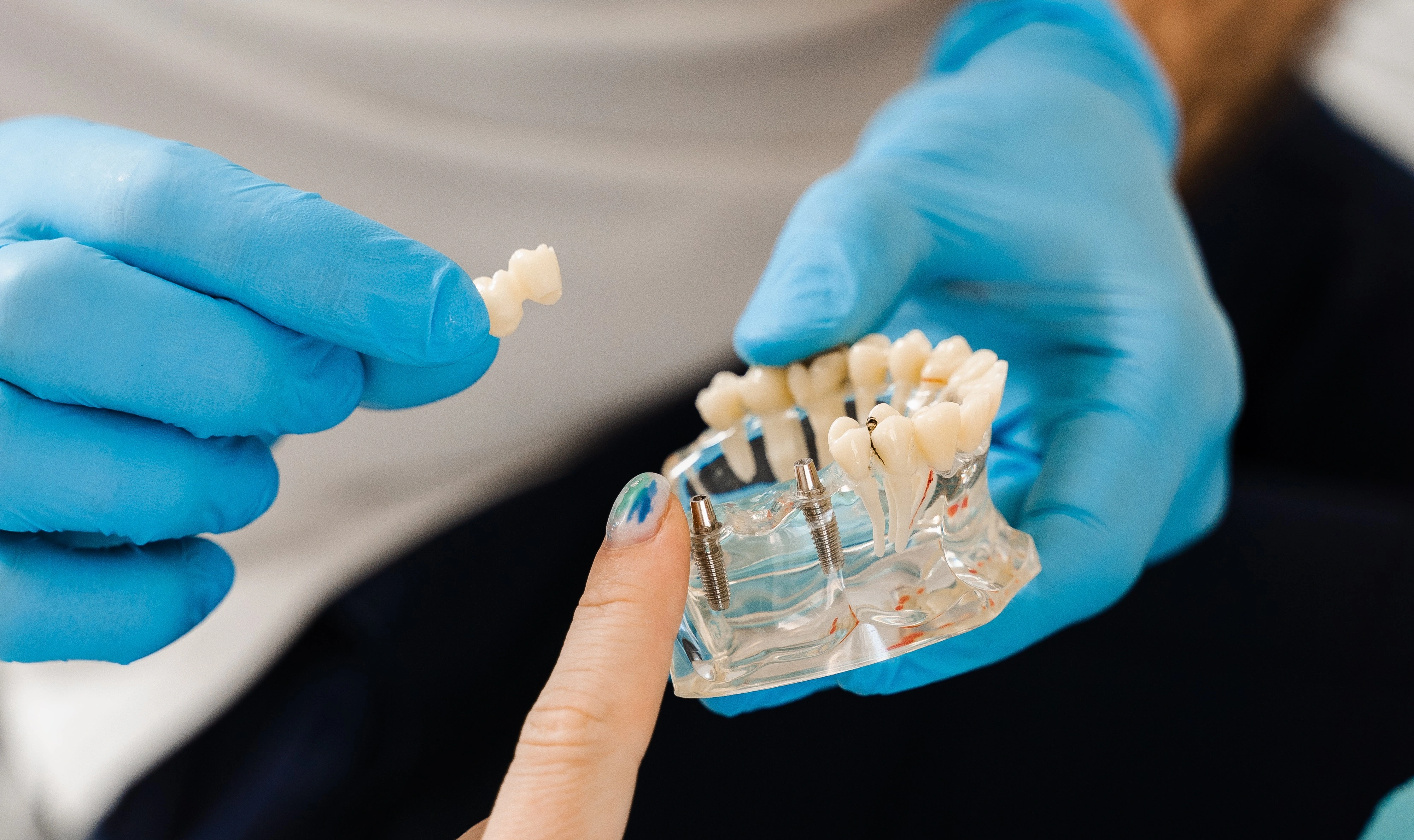 Der Arzt zeigt das Modell eines Kiefers, in dem zwei Implantate eingesetzt sind.